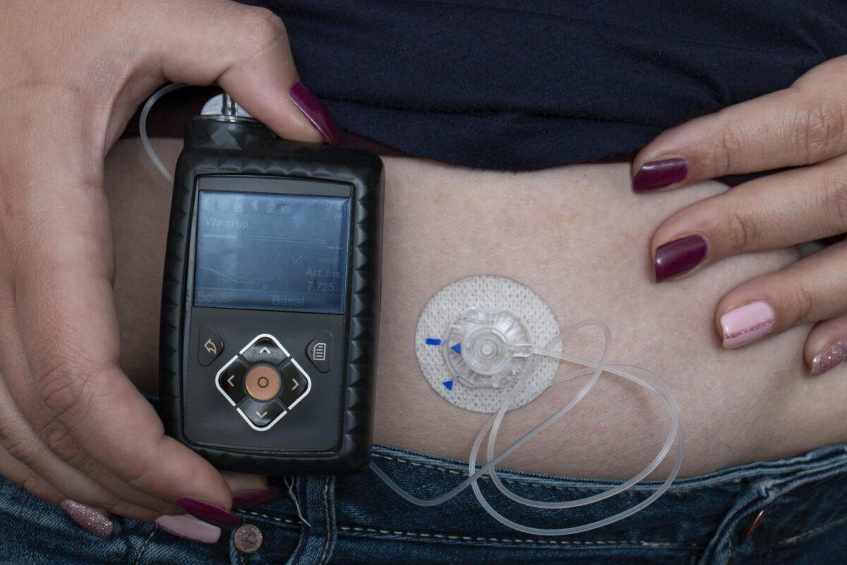 Woman wearing insulin pump to help control her diabetes